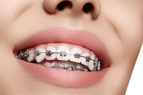 Types of Braces and Aligners Near Me in Midland, TX | Phillips Orthodontics