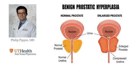 Benign Prostatic Hyperplasia Enlarged Prostate