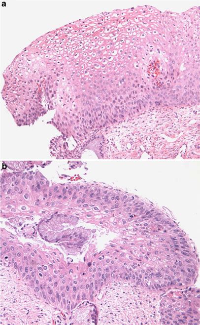 Histological ‘progression’ from low (LSIL) to high (HSIL) squamous ...