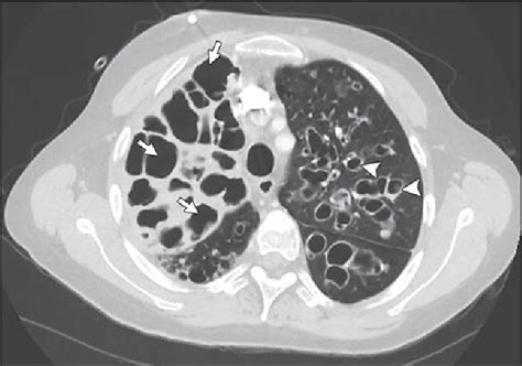 Imaging of Cystic Fibrosis and Pediatric Bronchiectasis. | Semantic Scholar