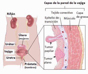 usted está torpe Flecha marcadores tumorales cancer de vejiga Memoria ...