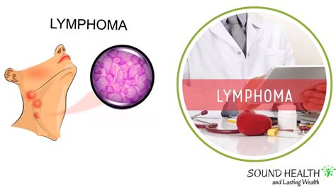 Final Stages of Mantle Cell Lymphoma: Prognosis, Treatment Options, and Support - USTimesPost