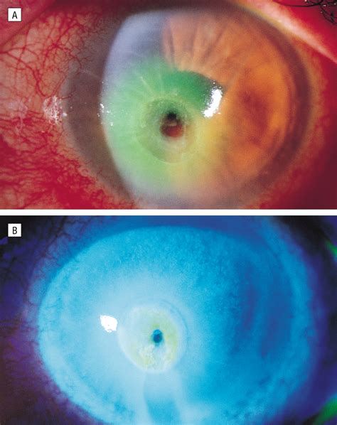 Corneal Melting Associated With Use of Topical Nonsteroidal Anti-inflammatory Drugs After Ocular ...