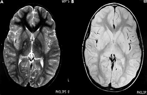 Unilateral lesions of the globus pallidus: report of four patients presenting with focal or ...