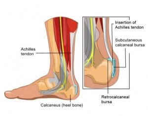 Bursitis Foot Treatment | Treatment For Foot Bursitis in Melbourne