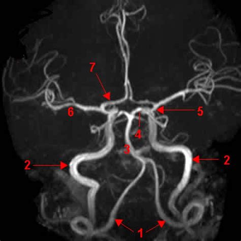 Circle of Willis (MRI - Axial) Diagram | Quizlet