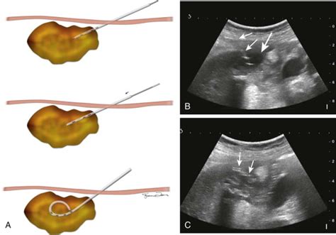 Abdominal Abscess | Radiology Key