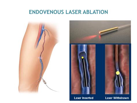 Endovenous Thermal Ablation Treatment in Mumbai - Dr. Avinash Katara Minimal Access Surgeon