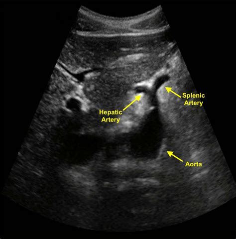 Ultrasound Abdominal Aorta Labeled | My XXX Hot Girl