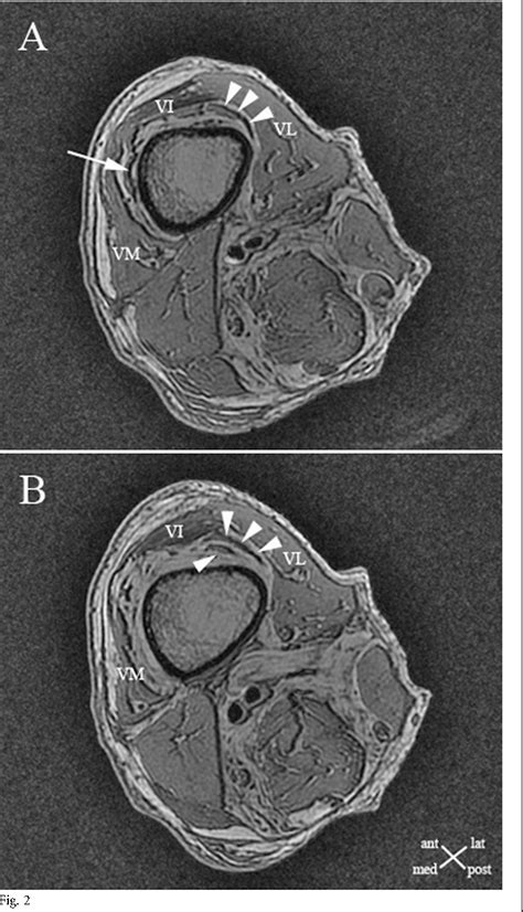 Figure 4 from Articularis genus: an anatomic and MRI study in cadavers ...