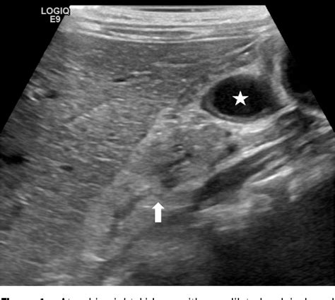 Figure 1 from Percutaneous Anterior Ureterostomy for Double J Ureteral Stent Placement in an 18 ...