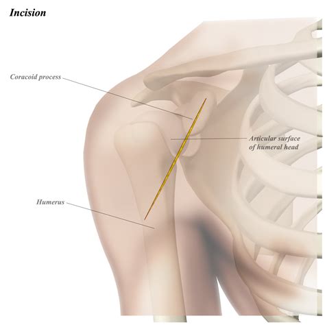 Shoulder Anterior (Deltopectoral) Approach - Approaches - Orthobullets