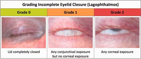 Eye care in the intensive care unit - Benjamin J Hearne, Elewys G Hearne, Hugh Montgomery, Susan ...