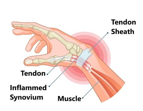 De Quervain’s Tenosynovitis Treatment For Wrist & Thumb Pain