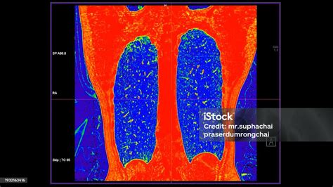 Photo libre de droit de Ct Scan Of Chest Coronal View In Color Mode For Diagnostic Pulmonary ...