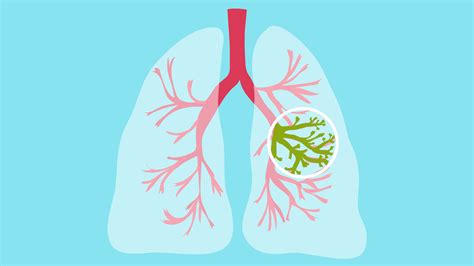 Cystic Fibrosis Symptoms and Diagnosis