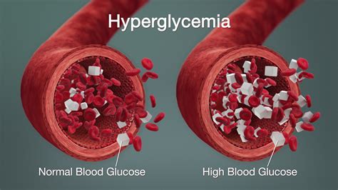 Hyperglycemia: Symptoms, Causes, Complications, and Treatment ...