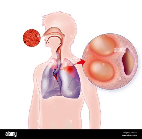 PULMONARY TUBERCULOSIS, DRAWING Stock Photo - Alamy