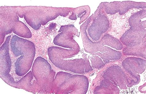 episodio Non si muove scrittura inverted papilloma histology ...