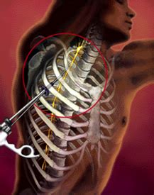 Endoscopic Sympathectomy Surgery - The Spine Practice of J.Patrick ...