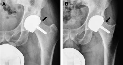 Imaging of Metal-On-Metal Hip Resurfacing | Musculoskeletal Key