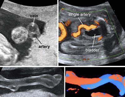 WK 6 L 2 Single umbilical artery Ultrasound Atlas | GLOWM | Medical ultrasound, Ultrasound ...