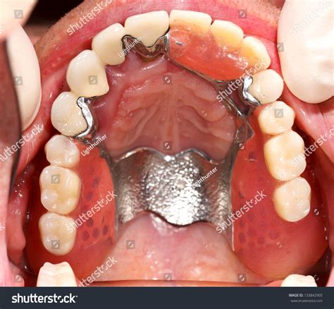 Free photo: Dental prosthesis - Dental, Teeth - Free Download - Jooinn