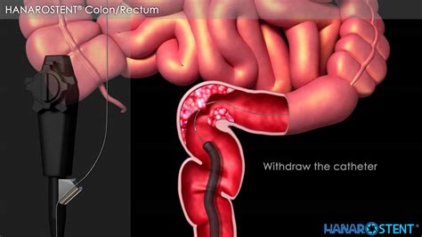 Hanaro Colonic Stent Demonstration Video - YouTube