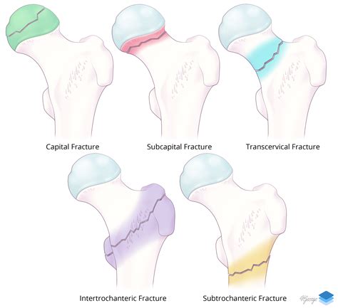 Femoral neck fracture symptoms - factorydiki