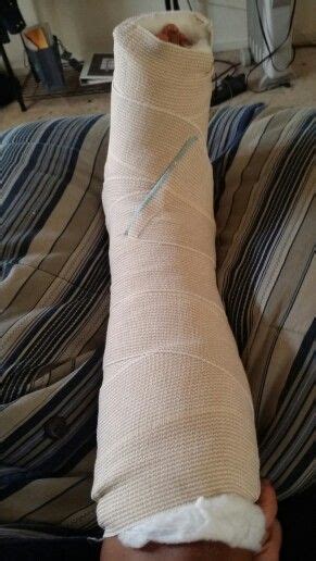 PTTD surgery recovery. Day 2 in bed with splint | Good feet | Pinterest | Beds and 2 in