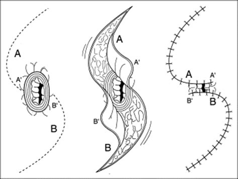 Anal stenosis - The American Journal of Surgery