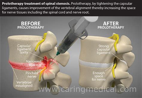 Non-surgical treatment options for lumbar spinal stenosis – Caring Medical