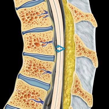 Epidural Lipomatosis Treatment - Infoupdate.org