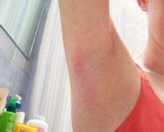 Grandmother’s Remedies For Treating Armpit Rash | Armpit rash, Underarm rash, Rashes remedies