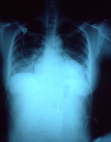 Lung congestion | Causes, Symptoms & Treatment | Britannica