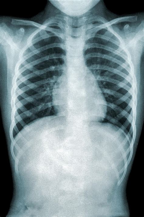 Pneumonia Chest Xray Photograph by Daniel Hagerman