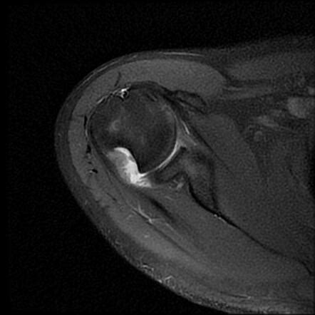 Hill-Sachs defect with bony Bankart lesion | Radiology Case | Radiopaedia.org