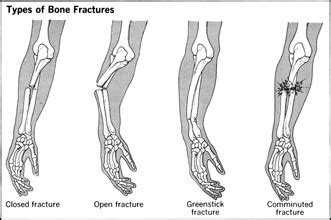 Injury to Bones and Joints: Fractures and Dislocations - blood, pain, body, infection, children ...