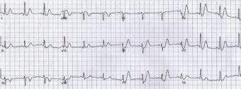 De Winter T Wave • LITFL • ECG Library Diagnosis