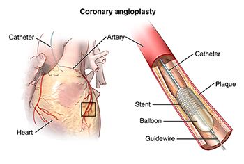 Atherosclerosis | Johns Hopkins Medicine