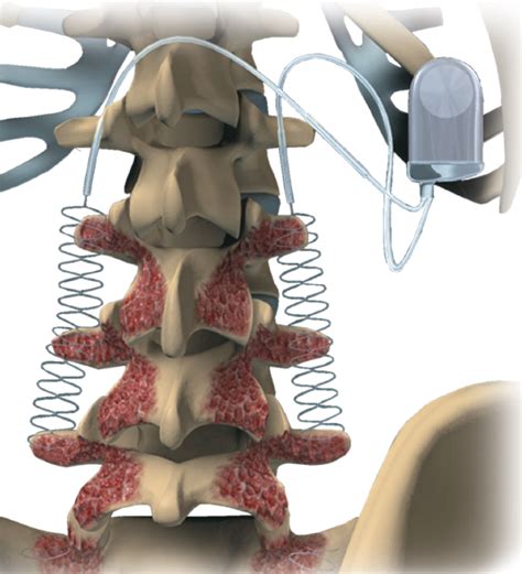 Bone stimulators - Questions and Answers in MRI