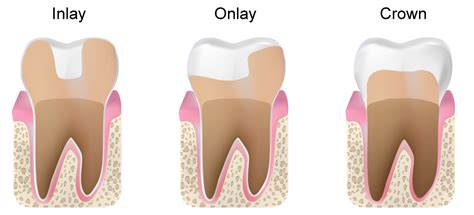 What are Inlay, Onlay, Composite Filling? - Royal Dental Clinics Blog