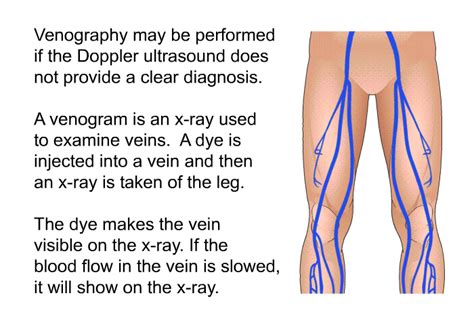 PatEdu.com : Deep Vein Thrombosis