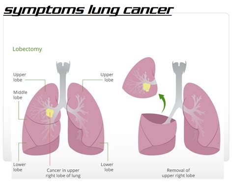 about lung cancer 3000: symptoms lung cancer