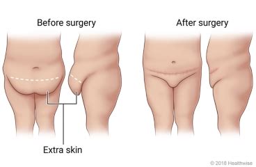 Panniculectomy: Before Your Surgery | Kaiser Permanente