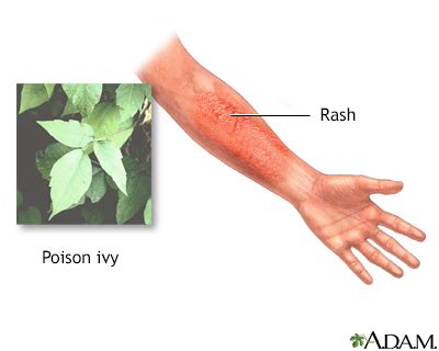 Poison Sumac Rash