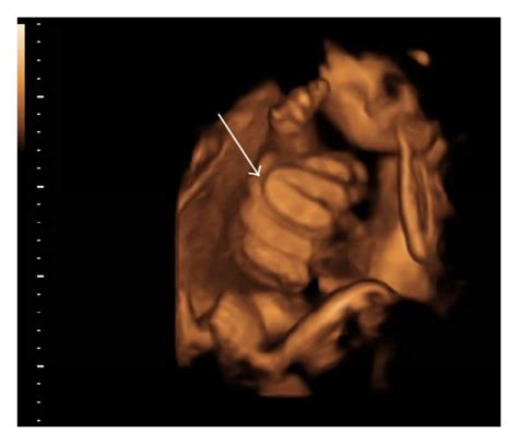 Ultrasound image demonstrating intra-abdominal loops of bowel... | Download Scientific Diagram