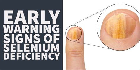 8 Early Symptoms of Selenium Deficiency & Your Next Steps