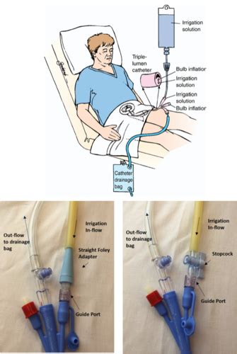 Continuous bladder irrigation after turp