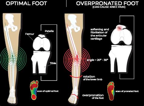 Do Insoles Help With Overpronation? | Running Shoes